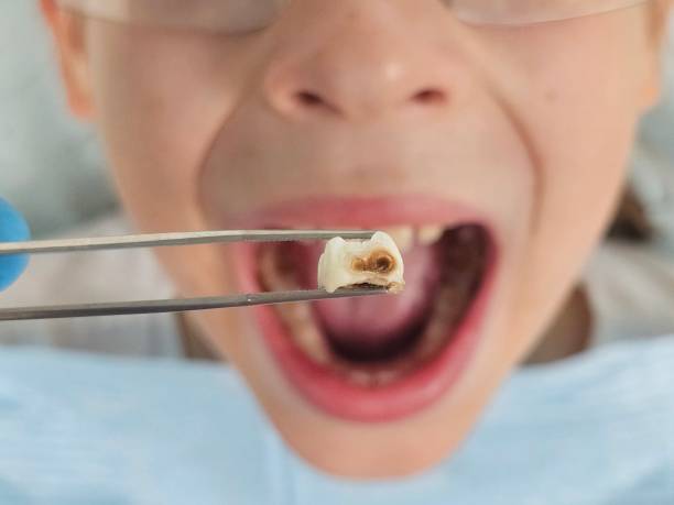 Best Urgent Care for Lost Fillings or Crowns in Aust, IN