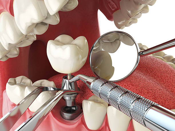 Best Emergency Tooth Extraction in Aust, IN